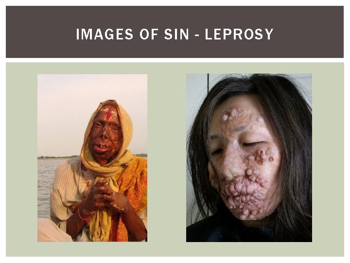 IMAGES OF SIN - LEPROSY 