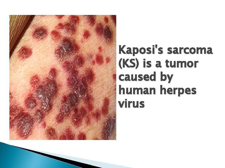 Kaposi's sarcoma (KS) is a tumor caused by human herpes virus 