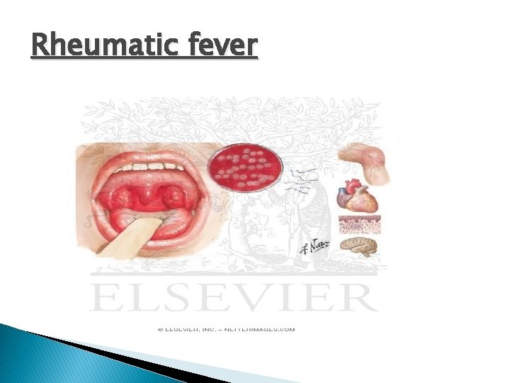 Rheumatic fever 