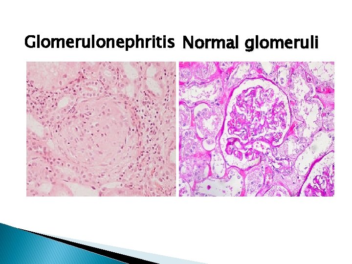 Glomerulonephritis Normal glomeruli 