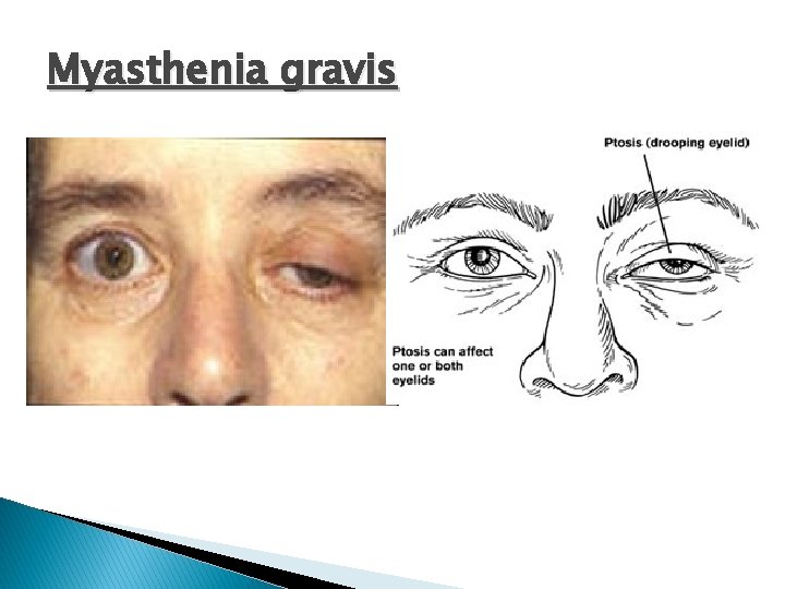  Myasthenia gravis 