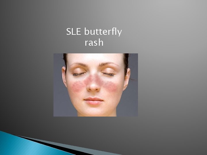 SLE butterfly rash 