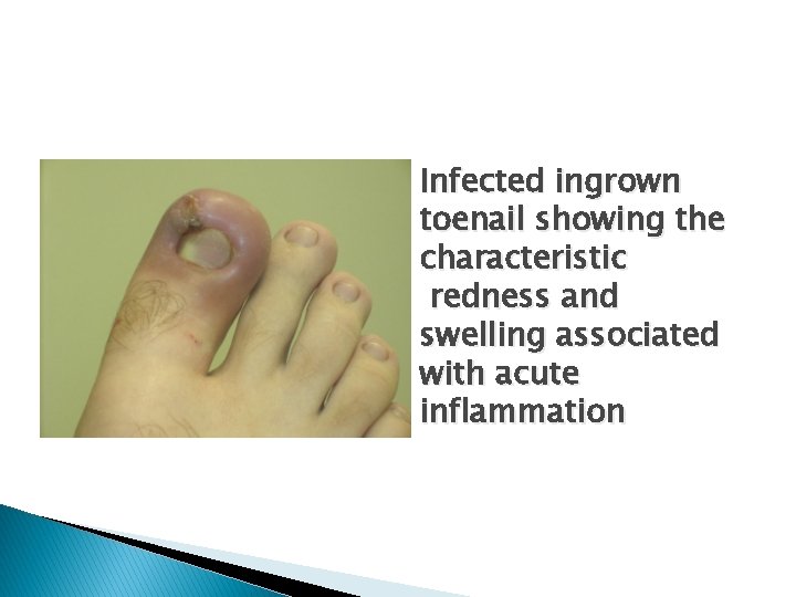 Infected ingrown toenail showing the characteristic redness and swelling associated with acute inflammation 