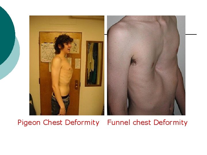 Pigeon Chest Deformity Funnel chest Deformity 