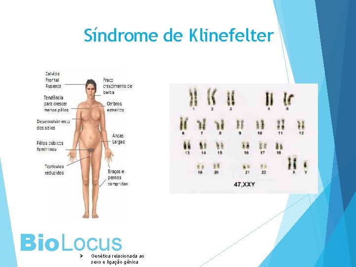 Síndrome de Klinefelter Bio. Locus Ø Genética relacionada ao sexo e ligação gênica 