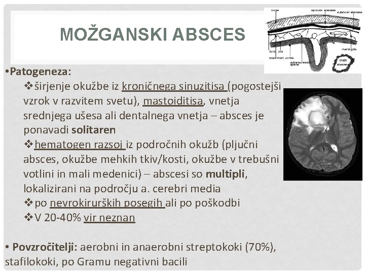 MOŽGANSKI ABSCES • Patogeneza: vširjenje okužbe iz kroničnega sinuzitisa (pogostejši vzrok v razvitem svetu),