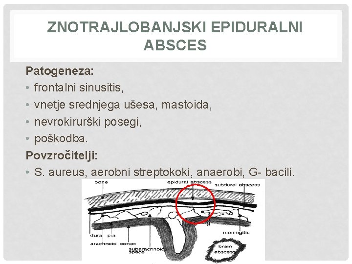 ZNOTRAJLOBANJSKI EPIDURALNI ABSCES Patogeneza: • frontalni sinusitis, • vnetje srednjega ušesa, mastoida, • nevrokirurški