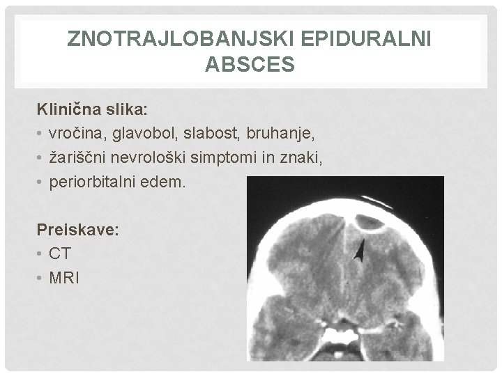 ZNOTRAJLOBANJSKI EPIDURALNI ABSCES Klinična slika: • vročina, glavobol, slabost, bruhanje, • žariščni nevrološki simptomi