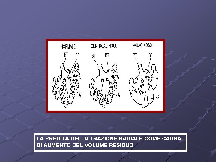 LA PREDITA DELLA TRAZIONE RADIALE COME CAUSA DI AUMENTO DEL VOLUME RESIDUO 