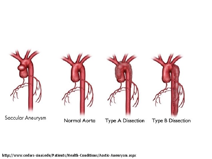 http: //www. cedars-sinai. edu/Patients/Health-Conditions/Aortic-Aneurysm. aspx 
