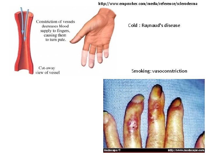 http: //www. empowher. com/media/reference/scleroderma Cold : Raynaud's disease Smoking: vasoconstriction 