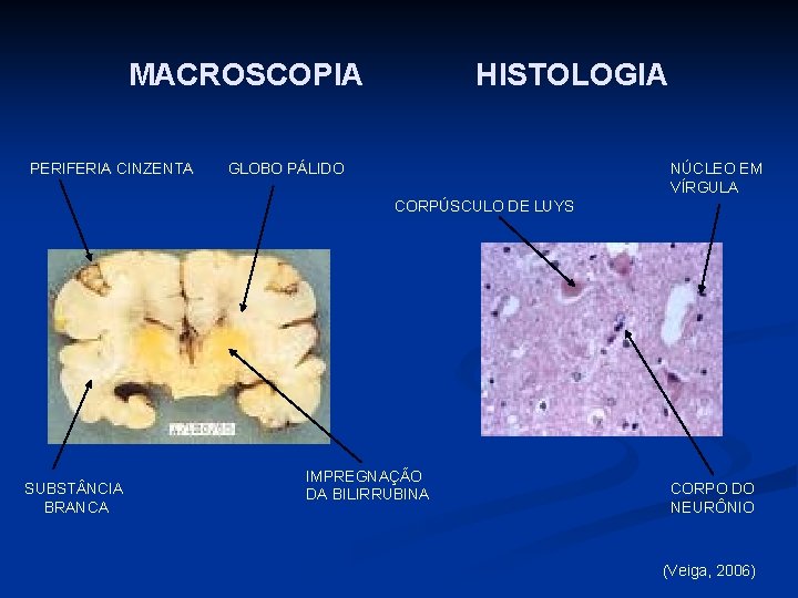 MACROSCOPIA HISTOLOGIA PERIFERIA CINZENTA GLOBO PÁLIDO NÚCLEO EM VÍRGULA CORPÚSCULO DE LUYS SUBST NCIA