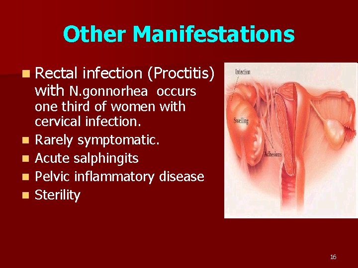 Other Manifestations n Rectal infection (Proctitis) with N. gonnorhea occurs n n one third