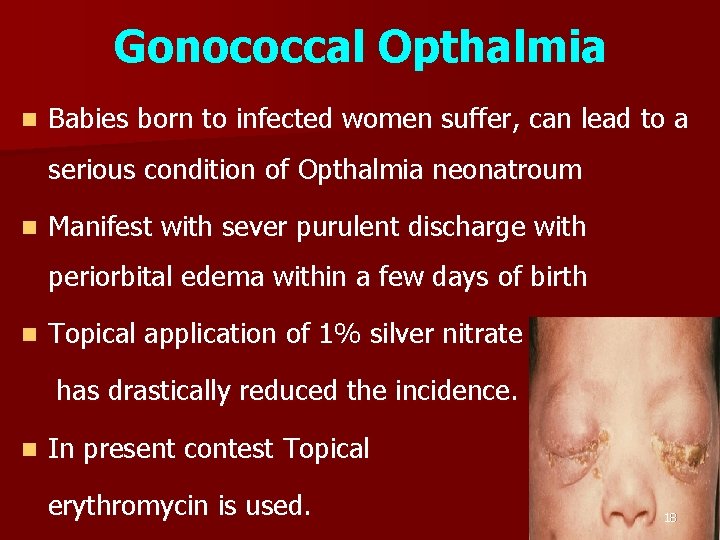 Gonococcal Opthalmia n Babies born to infected women suffer, can lead to a serious