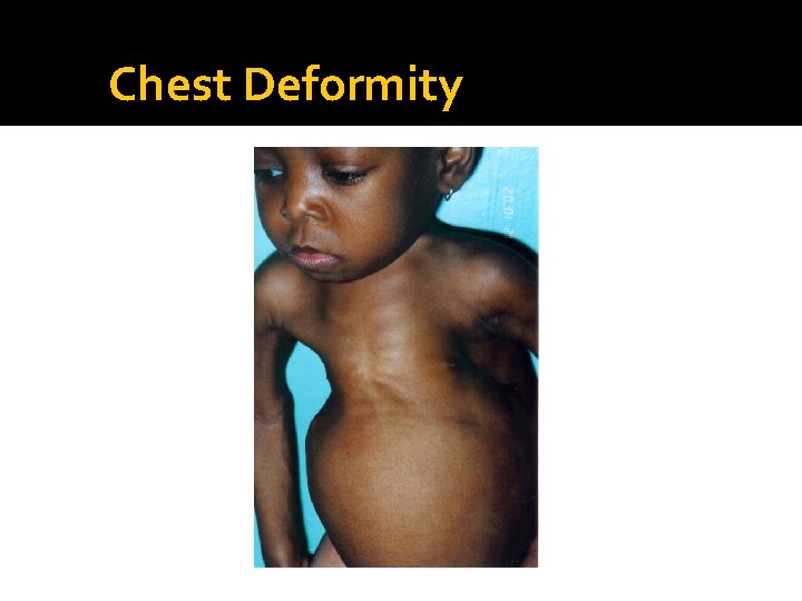 Chest Deformity 