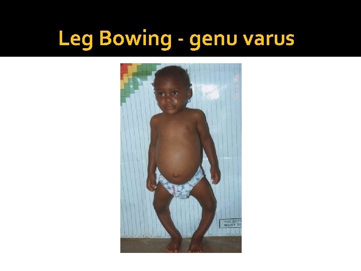 Leg Bowing - genu varus 