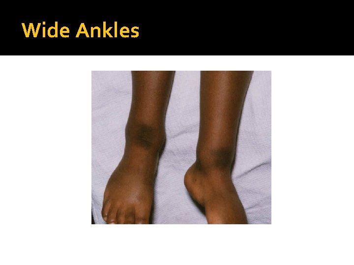 Wide Ankles 