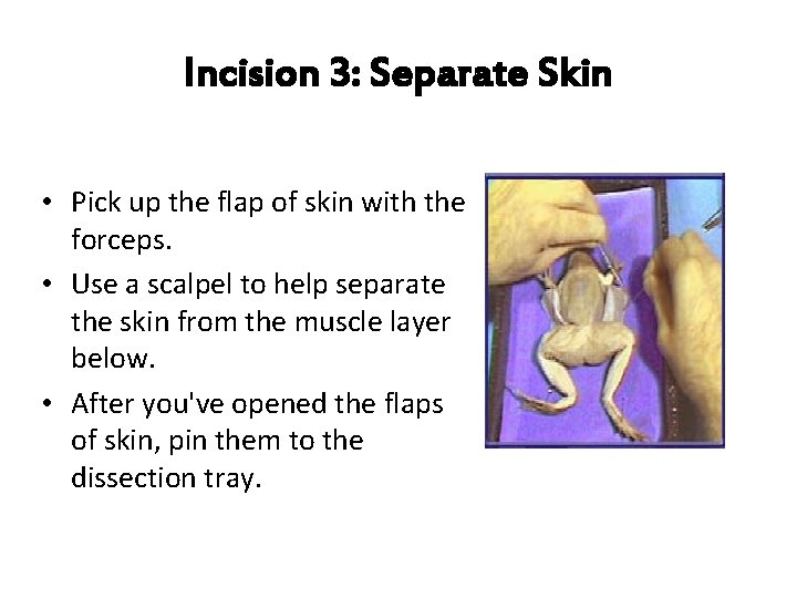 Incision 3: Separate Skin • Pick up the flap of skin with the forceps.