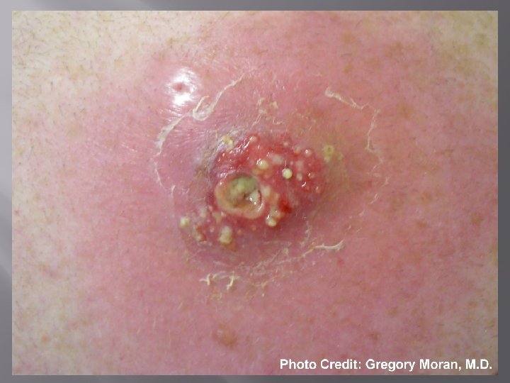 MRSA � � � Methicillin-resistant Staphylococcus Aureus Community – Typically a skin infection Medical