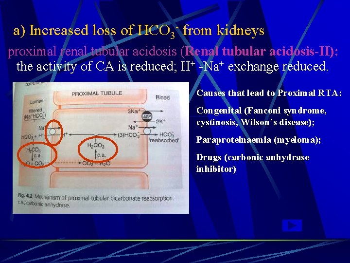 a) Increased loss of HCO 3 - from kidneys proximal renal tubular acidosis (Renal