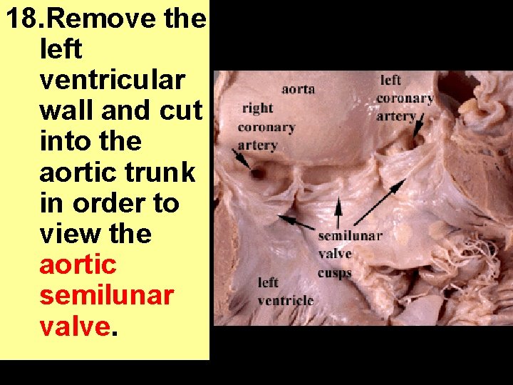 18. Remove the left ventricular wall and cut into the aortic trunk in order