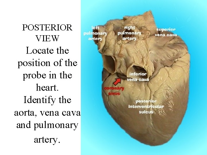 POSTERIOR VIEW Locate the position of the probe in the heart. Identify the aorta,