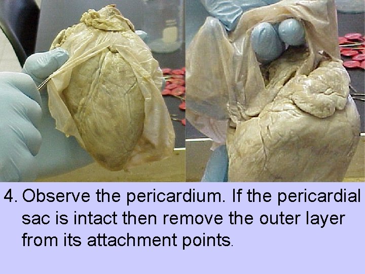 4. Observe the pericardium. If the pericardial sac is intact then remove the outer
