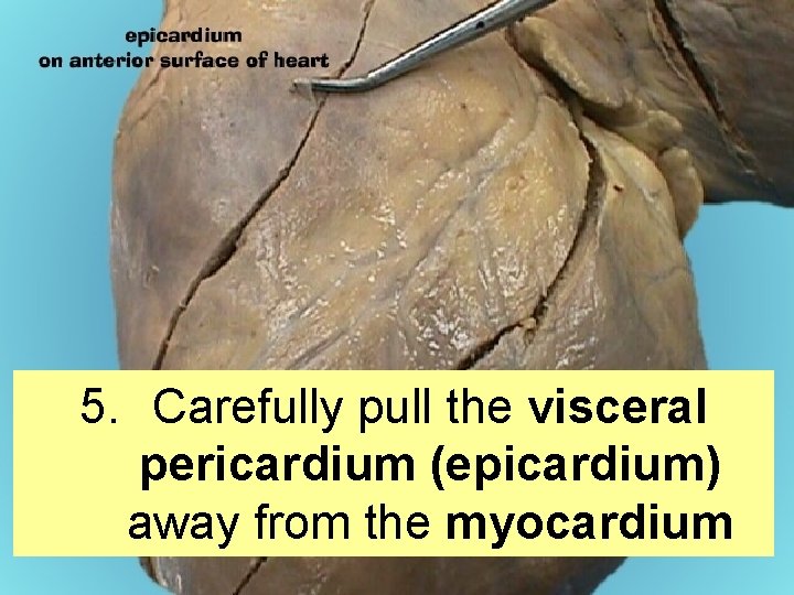 5. Carefully pull the visceral pericardium (epicardium) away from the myocardium 