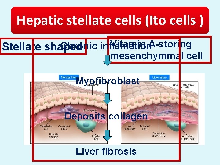 Hepatic stellate cells (Ito cells ) Vitamin A-storing Chronic inflamation Stellate shaped mesenchymmal cell