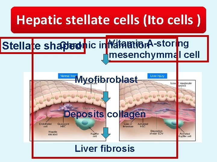 Hepatic stellate cells (Ito cells ) Vitamin A-storing Chronic inflamation Stellate shaped mesenchymmal cell