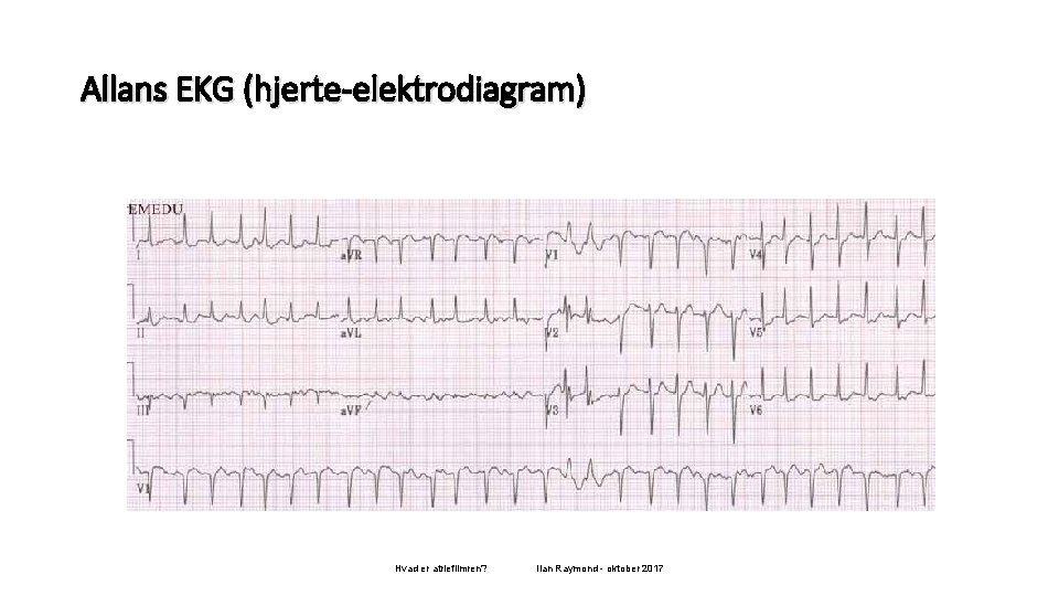 Allans EKG (hjerte-elektrodiagram) Hvad er atrieflimren? Ilan Raymond - oktober 2017 