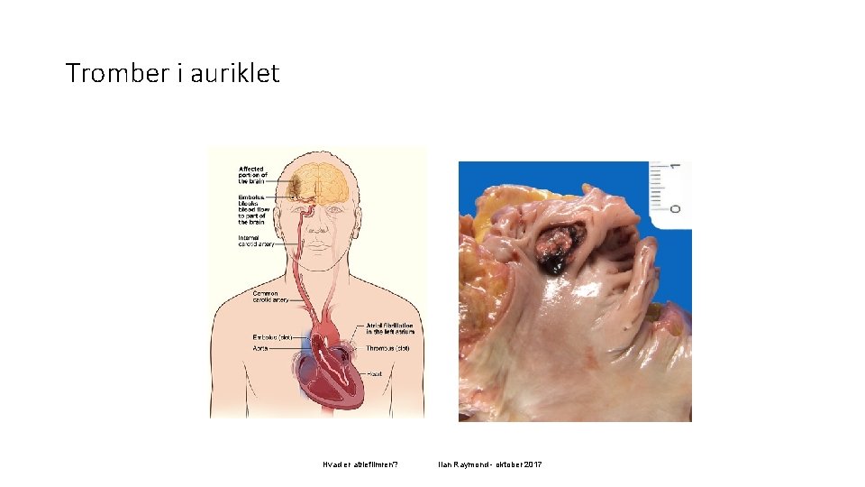 Tromber i auriklet Hvad er atrieflimren? Ilan Raymond - oktober 2017 