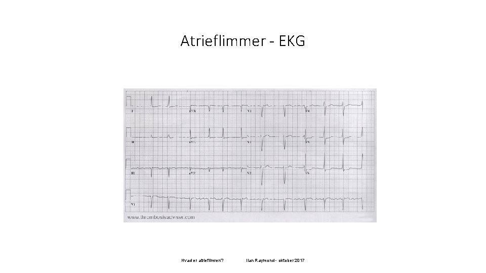 Atrieflimmer - EKG Hvad er atrieflimren? Ilan Raymond - oktober 2017 