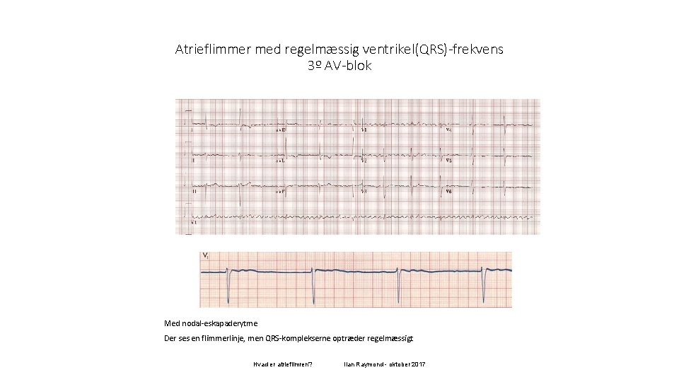 Atrieflimmer med regelmæssig ventrikel(QRS)-frekvens 3º AV-blok Med nodal-eskapaderytme Der ses en flimmerlinje, men QRS-komplekserne