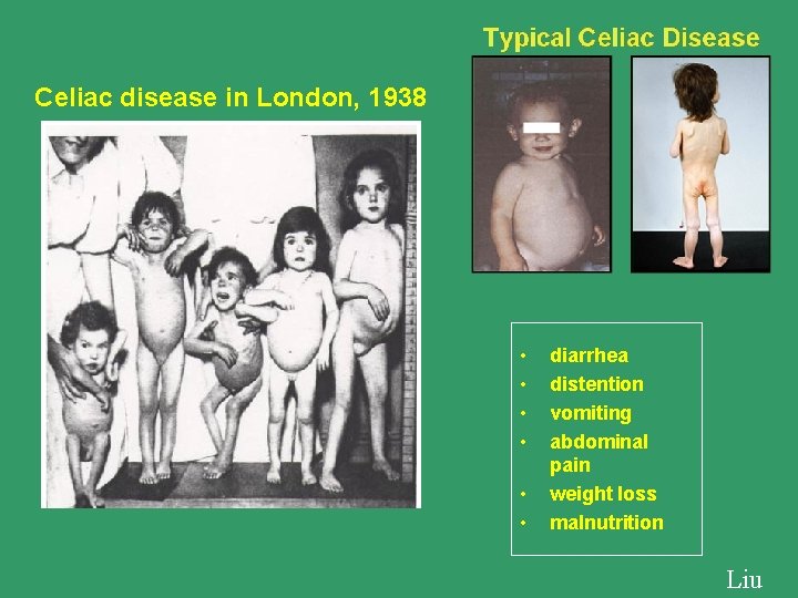 Celiac disease in London, 1938 • • • diarrhea distention vomiting abdominal pain weight