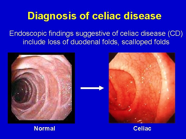 Diagnosis of celiac disease Endoscopic findings suggestive of celiac disease (CD) include loss of