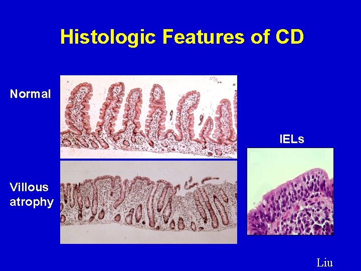 Histologic Features of CD Normal IELs Villous atrophy Liu 