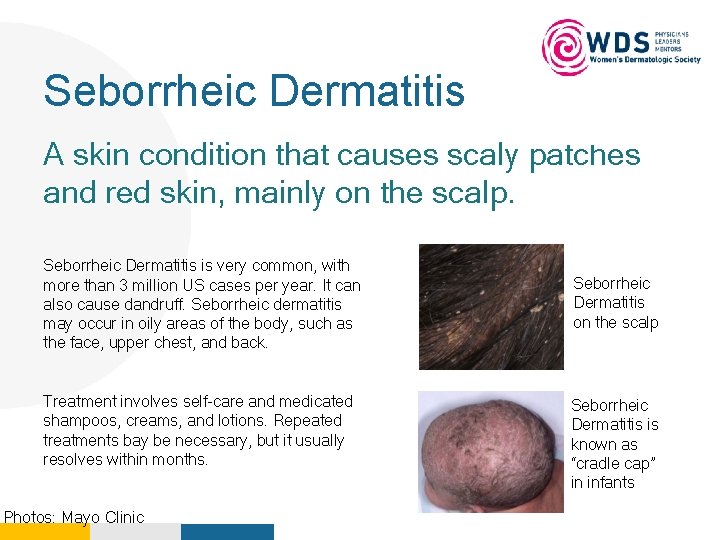 Seborrheic Dermatitis Your Logo Here A skin condition that causes scaly patches and red