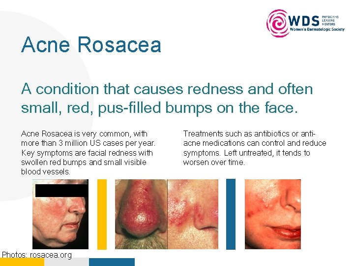 Acne Rosacea Your Logo Here A condition that causes redness and often small, red,