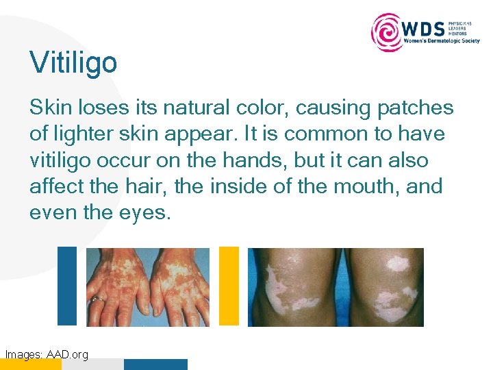 Vitiligo Your Logo Here Skin loses its natural color, causing patches of lighter skin