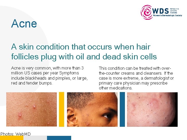 Your Logo Here Acne A skin condition that occurs when hair follicles plug with