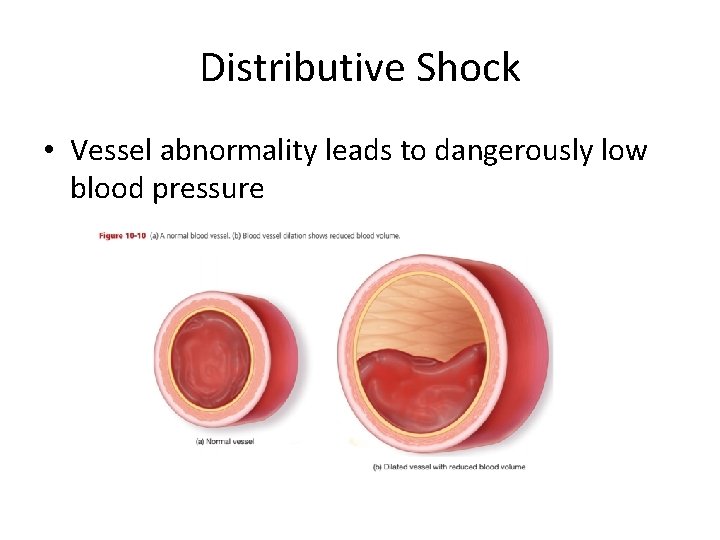 Distributive Shock • Vessel abnormality leads to dangerously low blood pressure 