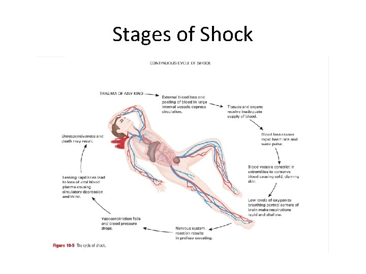 Stages of Shock 