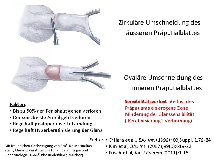 Zirkuläre Umschneidung des äusseren Präputialblattes Ovaläre Umschneidung des inneren Präputialblattes Fakten: • Bis zu
