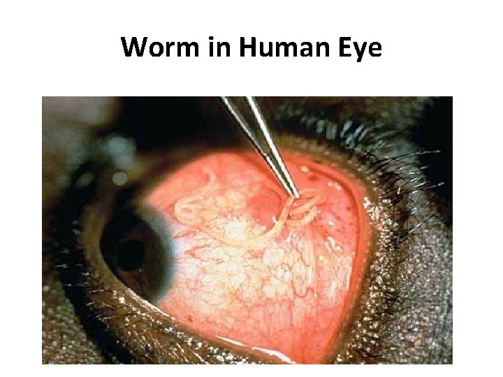 Worm in Human Eye 