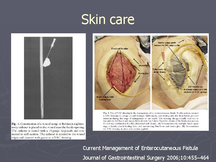 Skin care Current Management of Enterocutaneous Fistula Journal of Gastrointestinal Surgery 2006; 10: 455–