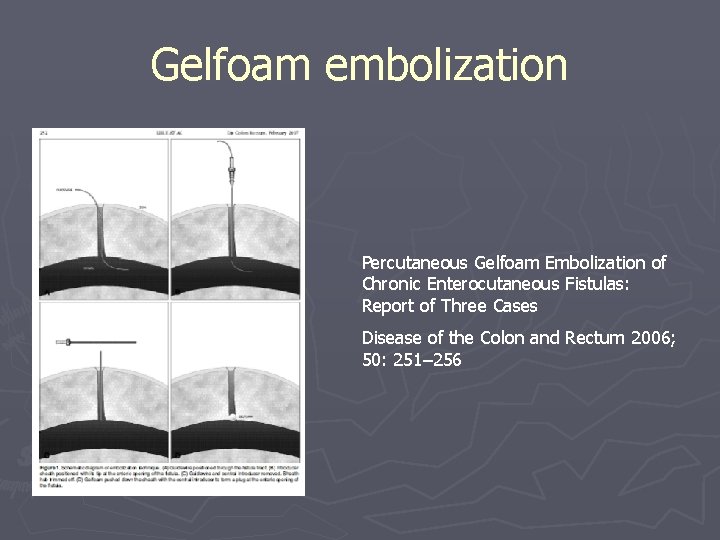Gelfoam embolization Percutaneous Gelfoam Embolization of Chronic Enterocutaneous Fistulas: Report of Three Cases Disease