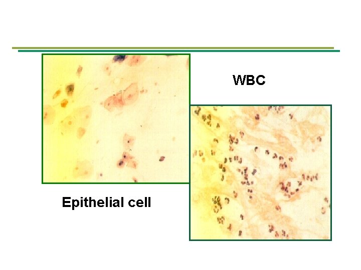 WBC Epithelial cell 