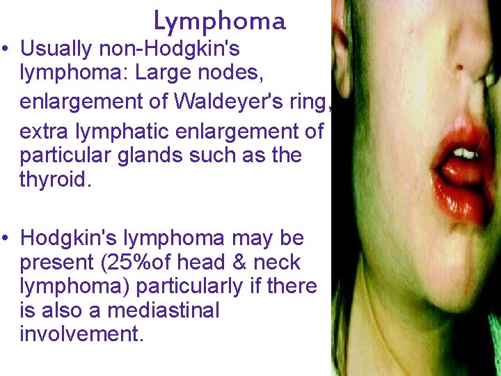 Lymphoma • Usually non-Hodgkin's lymphoma: Large nodes, enlargement of Waldeyer's ring, extra lymphatic enlargement