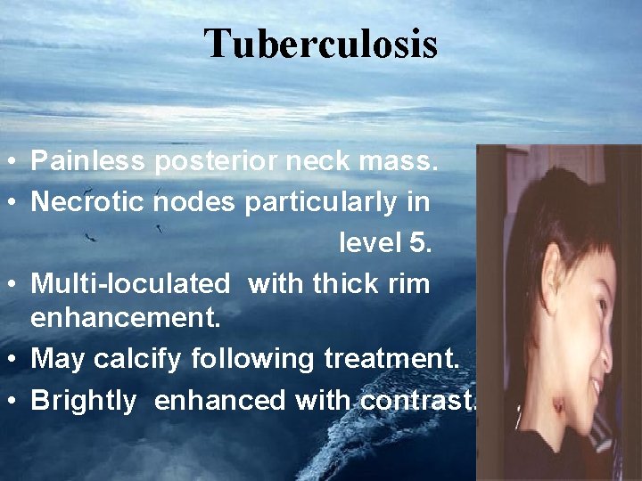 Tuberculosis • Painless posterior neck mass. • Necrotic nodes particularly in level 5. •